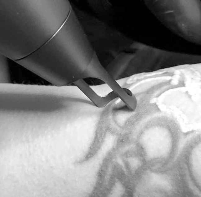 Laserbehandlung Tattooentfernung Oberarm BiAxis NANO Qs NdYAG by HLS Foto Copyright Doctare Laser 2025