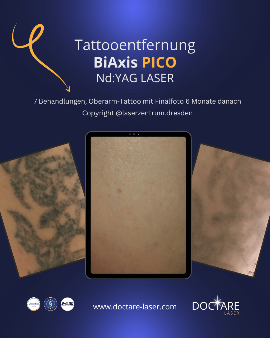Oberarm-Tattoo Blackwork BiAxis PICO Tattooentfernung by Laserzentrum Dresden Copyright for Doctare Laser 2025