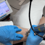 Pikosekunden-Laser für die Tattooentfernung Foto Copyright Doctare Laser 2026