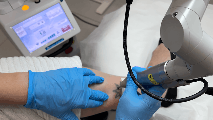 Pikosekunden-Laser für die Tattooentfernung Foto Copyright Doctare Laser 2026