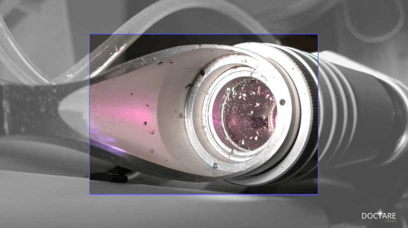 Verschmutztes Laser-Handstück mit Pigmentablagerungen im Nd:YAG-Handstück Abstandshalter Schutzglas Copyright Doctare Laser 2026
