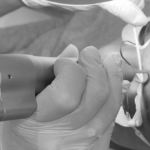 PMU-Entfernung mit dem BiAxis PICO NdYAG Laser Tattoo Remove Agis Zurich Schweiz Foto Copyright Doctare-Laser 2026