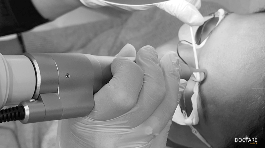 PMU-Entfernung mit dem BiAxis PICO NdYAG Laser Tattoo Remove Agis Zurich Schweiz Foto Copyright Doctare-Laser 2026
